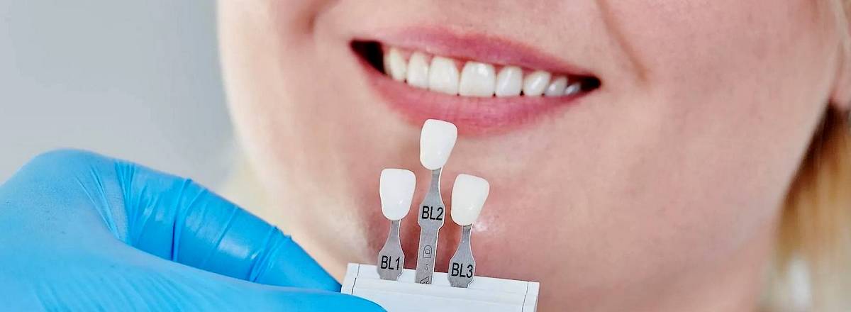 Image result for dental veneers