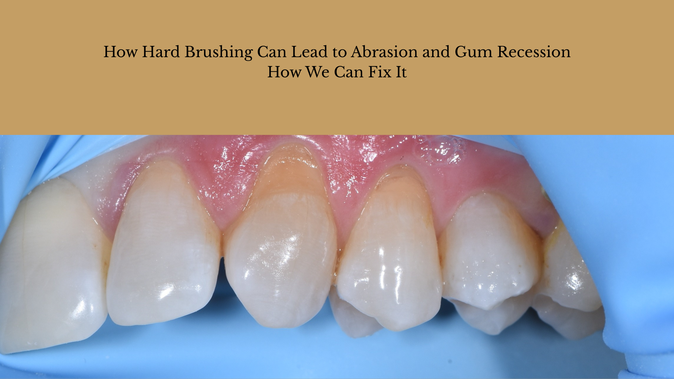 How Hard Brushing Can Lead to Abrasion and Gum Recession How Hard Brushing Can Lead to Abrasion and Gum Recession
