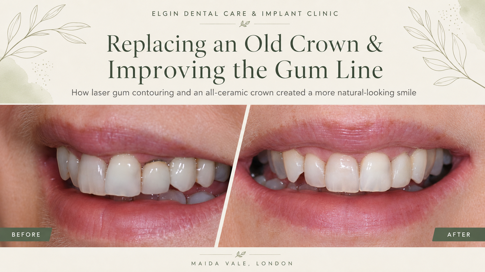 Replacing an Old Crown and Improving the Gum Line: A Natural-Looking Smile Transformation